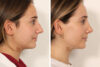 Rhinoplasty case #4112 slider thumbnail