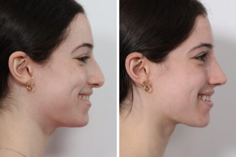 Rhinoplasty case #3950
