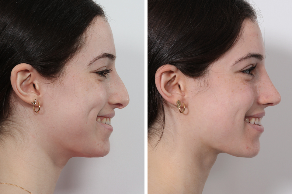 Rhinoplasty case #3950