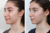 Rhinoplasty case #4118 slider thumbnail