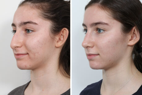 Rhinoplasty case #4118