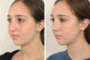 Rhinoplasty case #4123 slider thumbnail