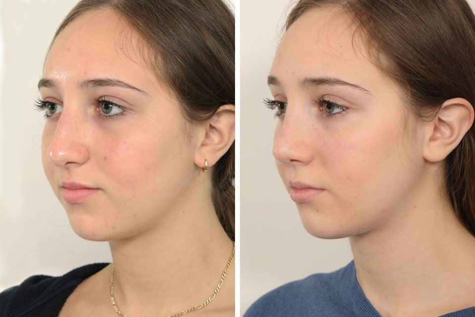 Rhinoplasty case #4123