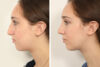 Rhinoplasty case #4123 slider thumbnail