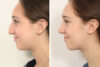 Rhinoplasty case #4123 slider thumbnail
