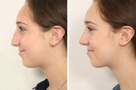 Rhinoplasty case #4123