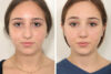 Rhinoplasty case #4123 slider thumbnail