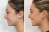Rhinoplasty case #4041 slider thumbnail