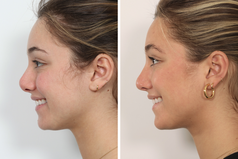 Rhinoplasty case #4041