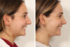 Rhinoplasty case #4112 slider thumbnail