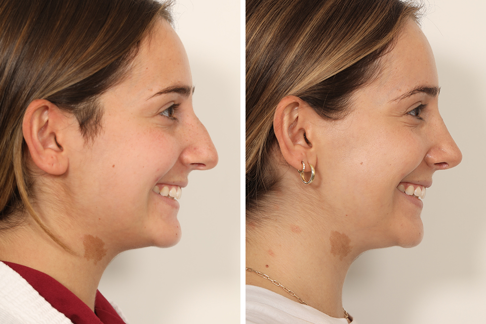 Rhinoplasty case #4112