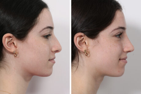 Rhinoplasty case #3950