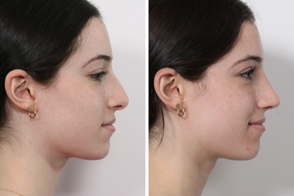 Rhinoplasty case #3950