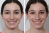Rhinoplasty case #3950 slider thumbnail