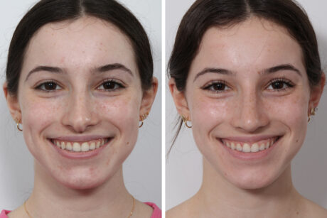 Rhinoplasty case #3950