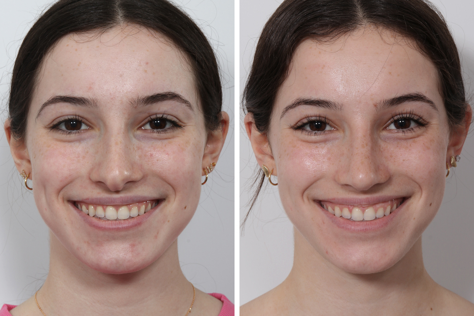Rhinoplasty case #3950