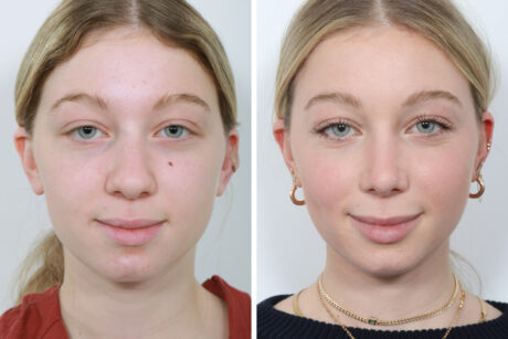 Rhinoplasty case #4159