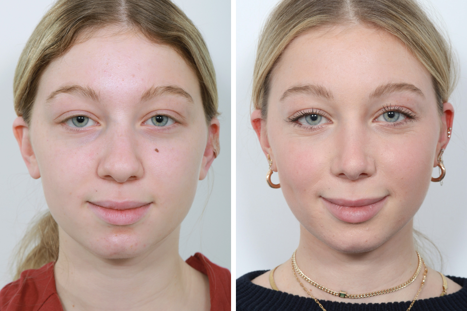 Rhinoplasty case #4159