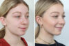 Rhinoplasty case #4159 slider thumbnail