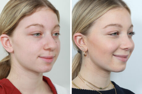 Rhinoplasty case #4159
