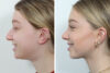 Rhinoplasty case #4159 slider thumbnail