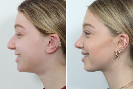 Rhinoplasty case #4159