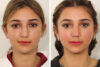 Rhinoplasty case #4102 slider thumbnail