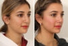 Rhinoplasty case #4102 slider thumbnail