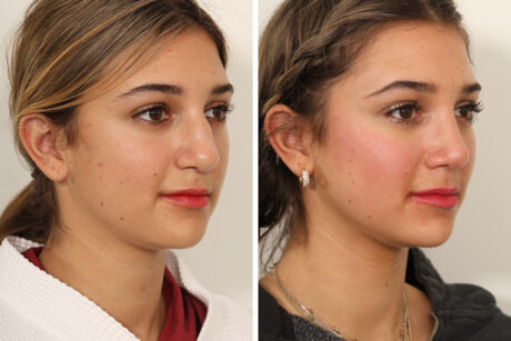 Rhinoplasty case #4102