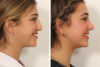 Rhinoplasty case #4102 slider thumbnail