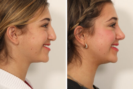 Rhinoplasty case #4102
