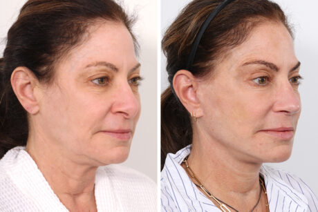 Rhinoplasty case #4092