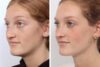 Rhinoplasty case #3963 slider thumbnail