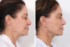 Rhinoplasty case #4092 slider thumbnail