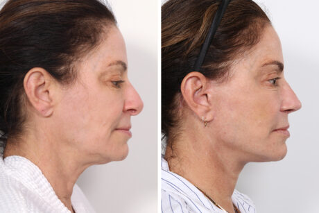 Rhinoplasty case #4092