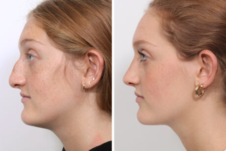 Rhinoplasty case #3963