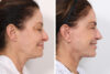Rhinoplasty case #4092 slider thumbnail