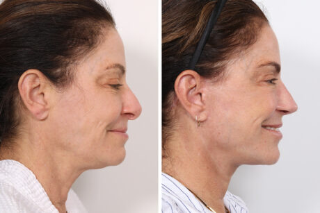 Rhinoplasty case #4092