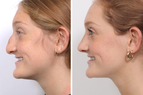 Rhinoplasty case #3963