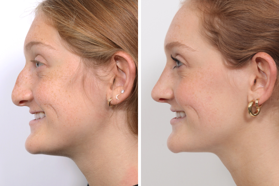 Rhinoplasty case #3963