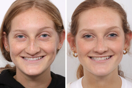 Rhinoplasty case #3963