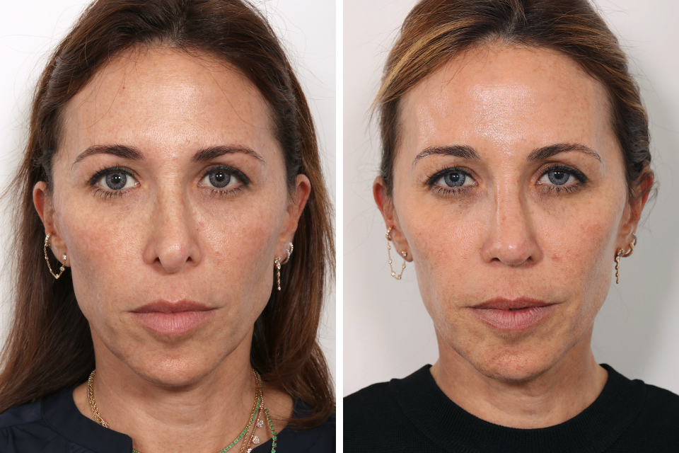 Rhinoplasty case #3961