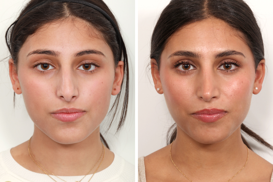 Rhinoplasty case #4008