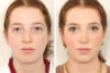 Rhinoplasty case #4050 slider thumbnail