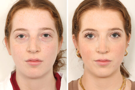 Rhinoplasty case #4050
