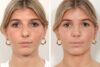 Rhinoplasty case #4070 slider thumbnail