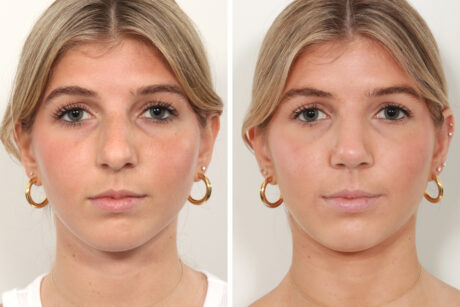Rhinoplasty case #4070