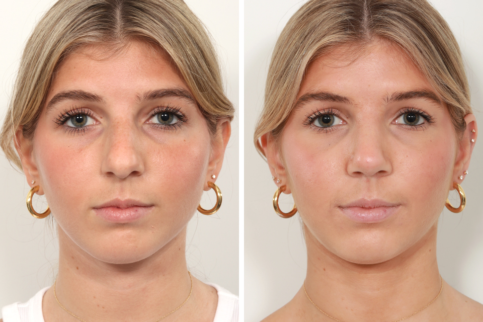 Rhinoplasty case #4070