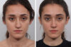 Rhinoplasty case #4075 slider thumbnail