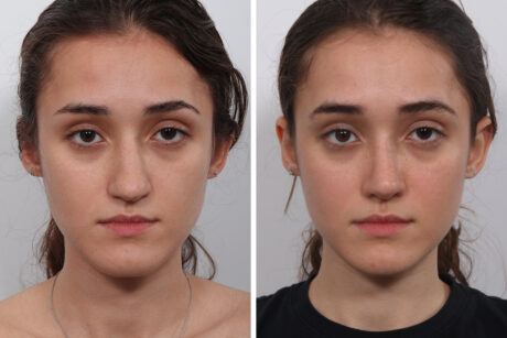 Rhinoplasty case #4075